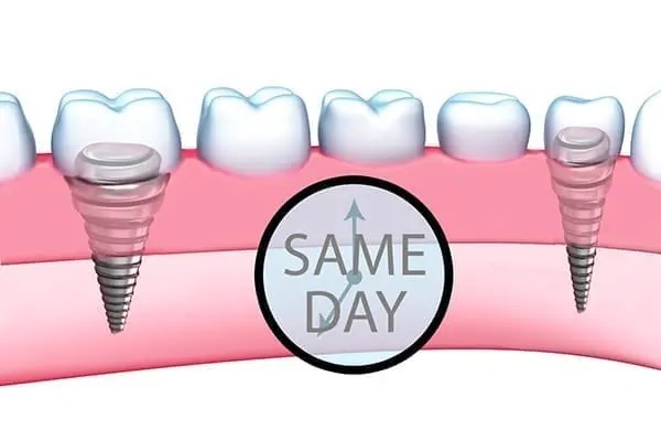 Same Day Teeth Navi Mumbai